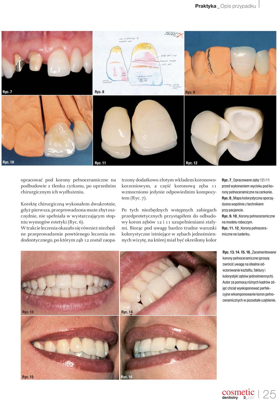 W trakcie leczenia okazało się również niezbędne przeprowadzenie powtórnego leczenia endodontycznego, po którym ząb 12 został zaopatrzony dodatkowo złotym wkładem koronowokorzeniowym, a część