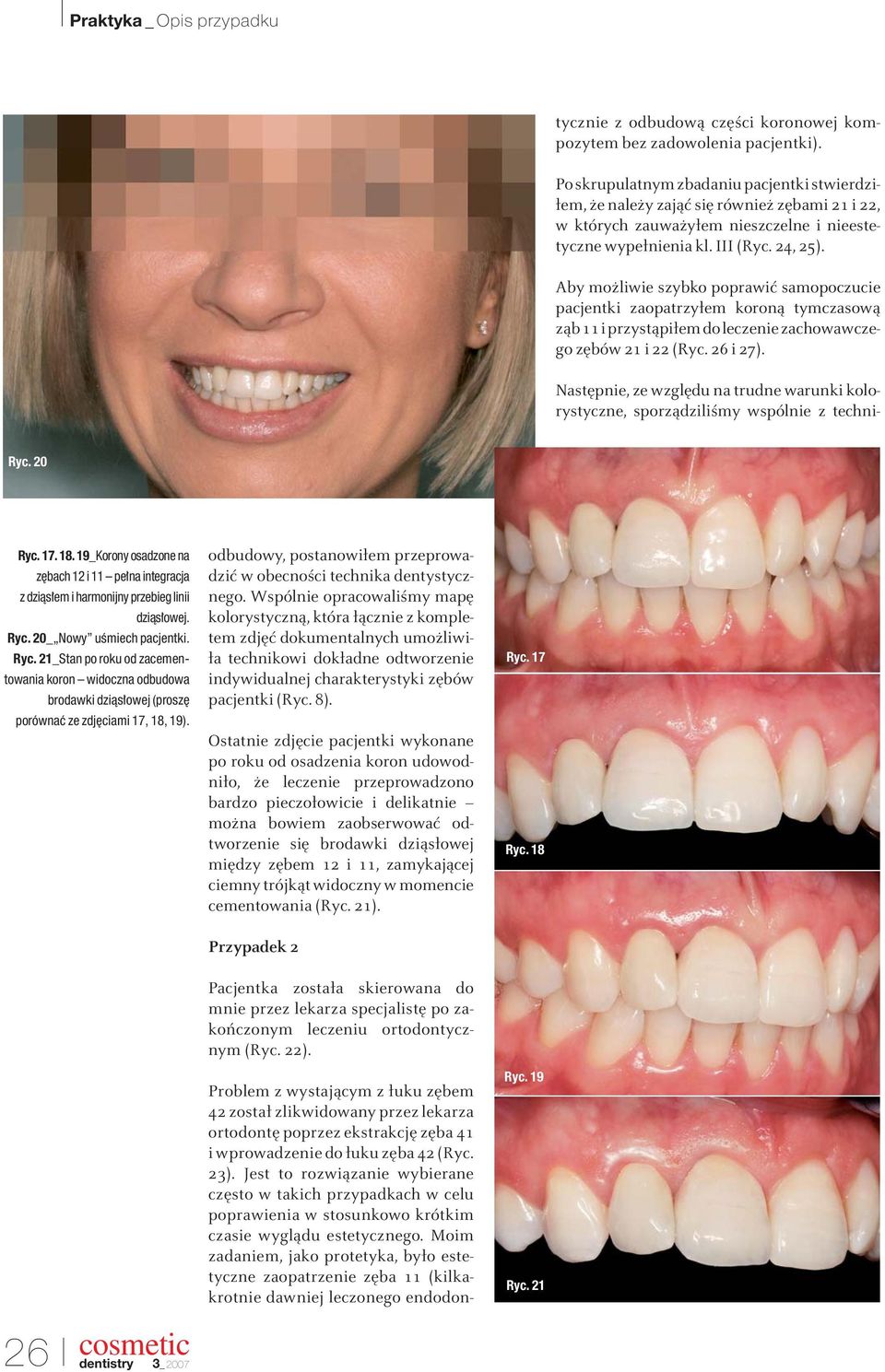 Moim zadaniem, jako protetyka, było estetyczne zaopatrzenie zęba 11 (kilkakrotnie dawniej leczonego endodontycznie z odbudową części koronowej kompozytem bez zadowolenia pacjentki).