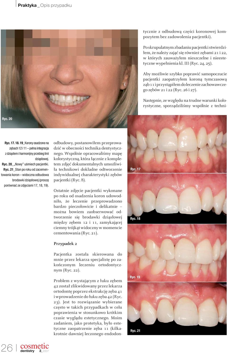 Moim zadaniem, jako protetyka, było estetyczne zaopatrzenie zęba 11 (kilkakrotnie dawniej leczonego endodontycznie z odbudową części koronowej kompozytem bez zadowolenia pacjentki).