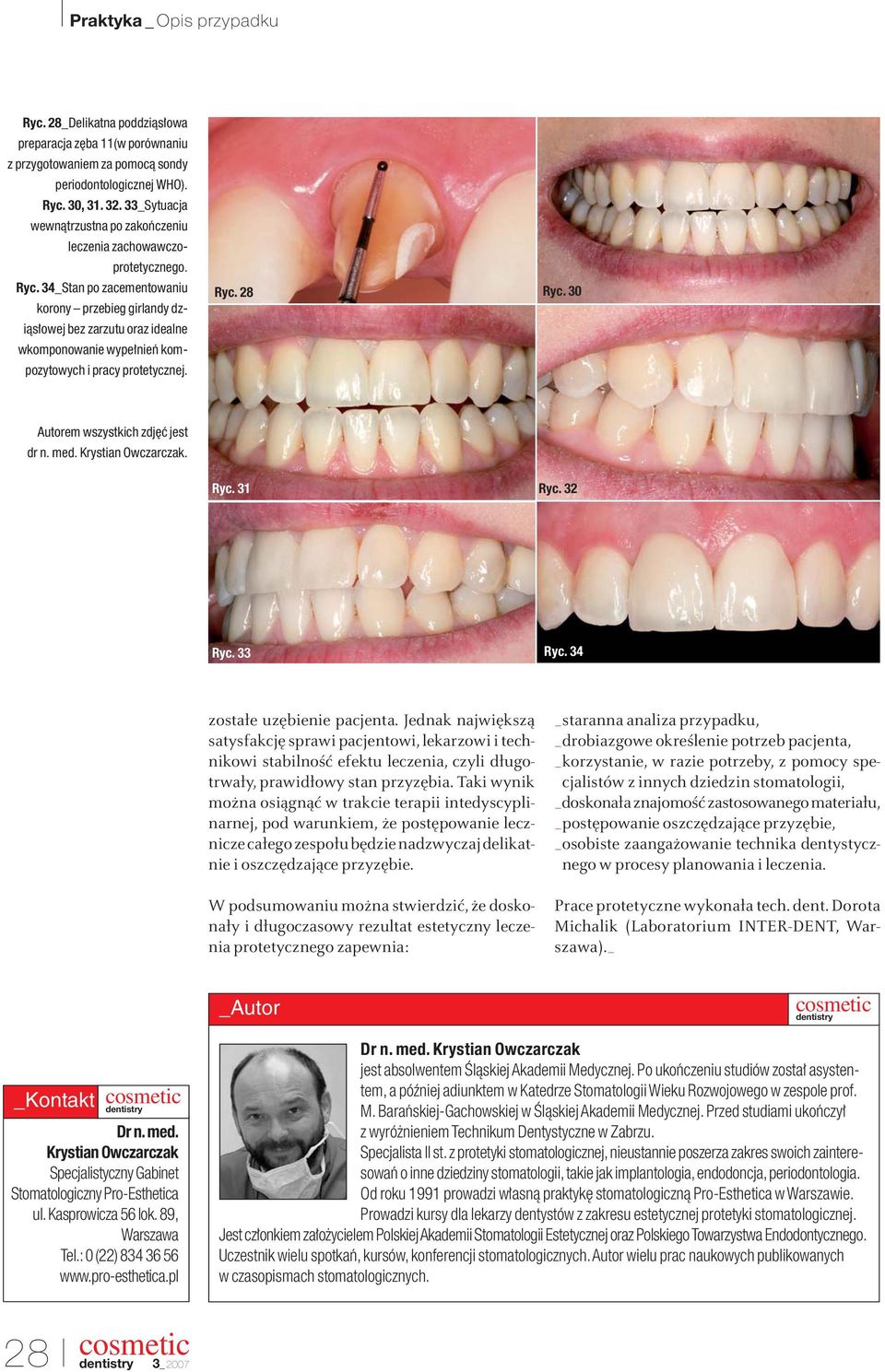34_Stan po zacementowaniu korony przebieg girlandy dziàs owej bez zarzutu oraz idealne wkomponowanie wype nieƒ kompozytowych i pracy protetycznej. Ryc. 28 Ryc. 30 Autorem wszystkich zdj ç jest dr n.