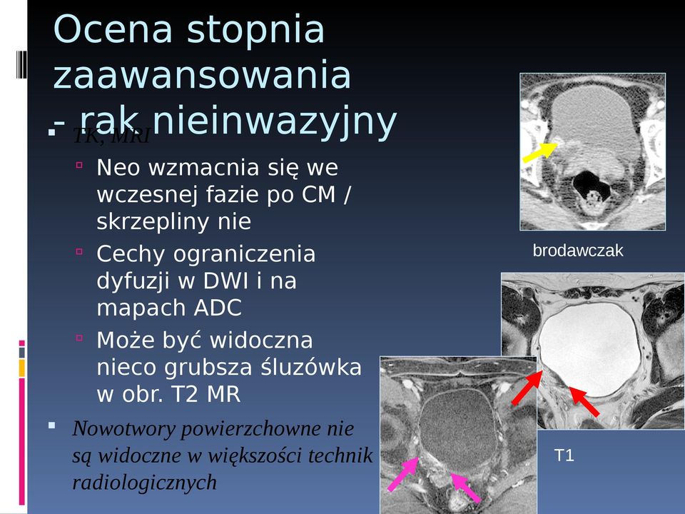 mapach ADC Może być widoczna nieco grubsza śluzówka w obr.