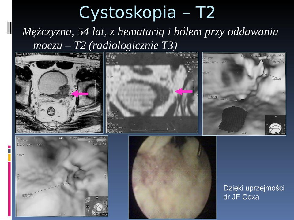 oddawaniu moczu T2