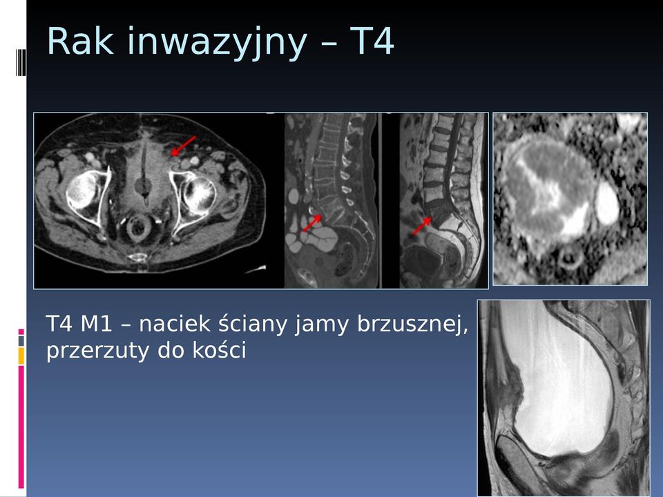 ściany jamy