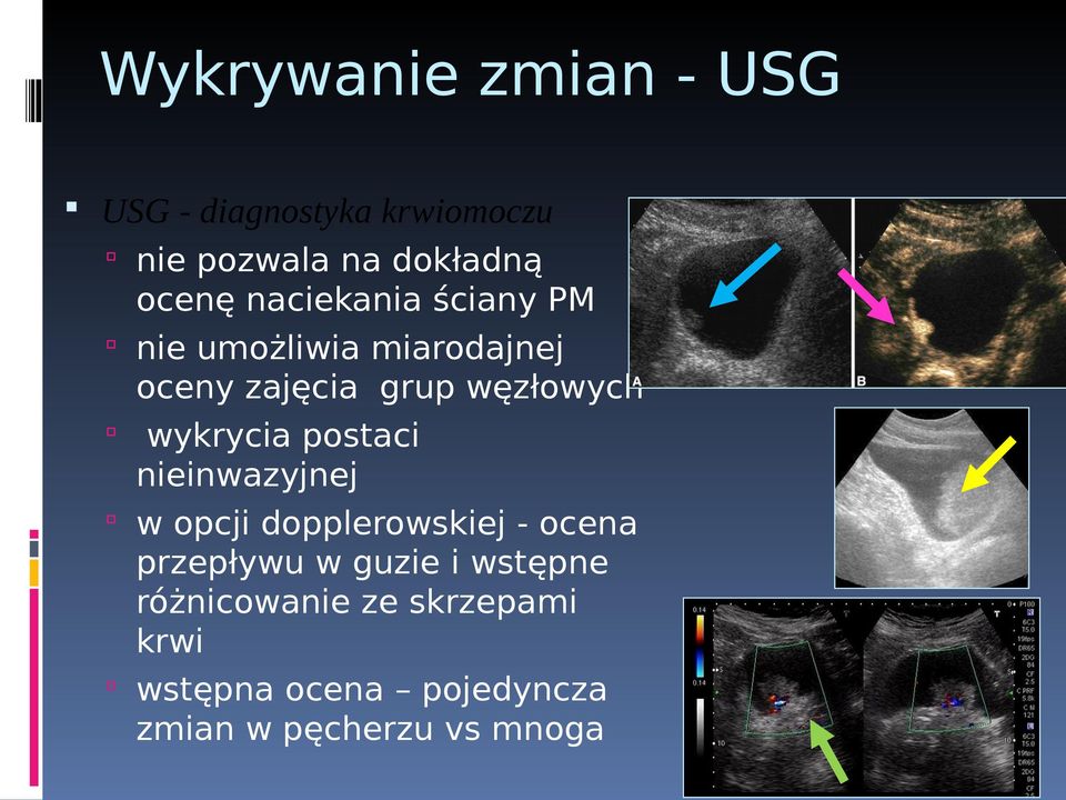 wykrycia postaci nieinwazyjnej w opcji dopplerowskiej - ocena przepływu w guzie i