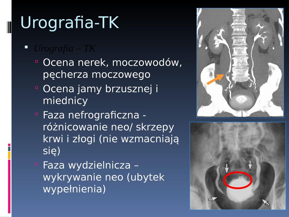 nefrograficzna różnicowanie neo/ skrzepy krwi i złogi (nie