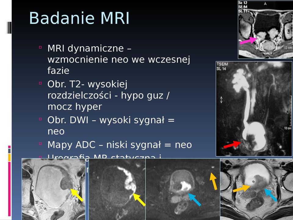 DWI wysoki sygnał = neo Mapy ADC niski sygnał = neo