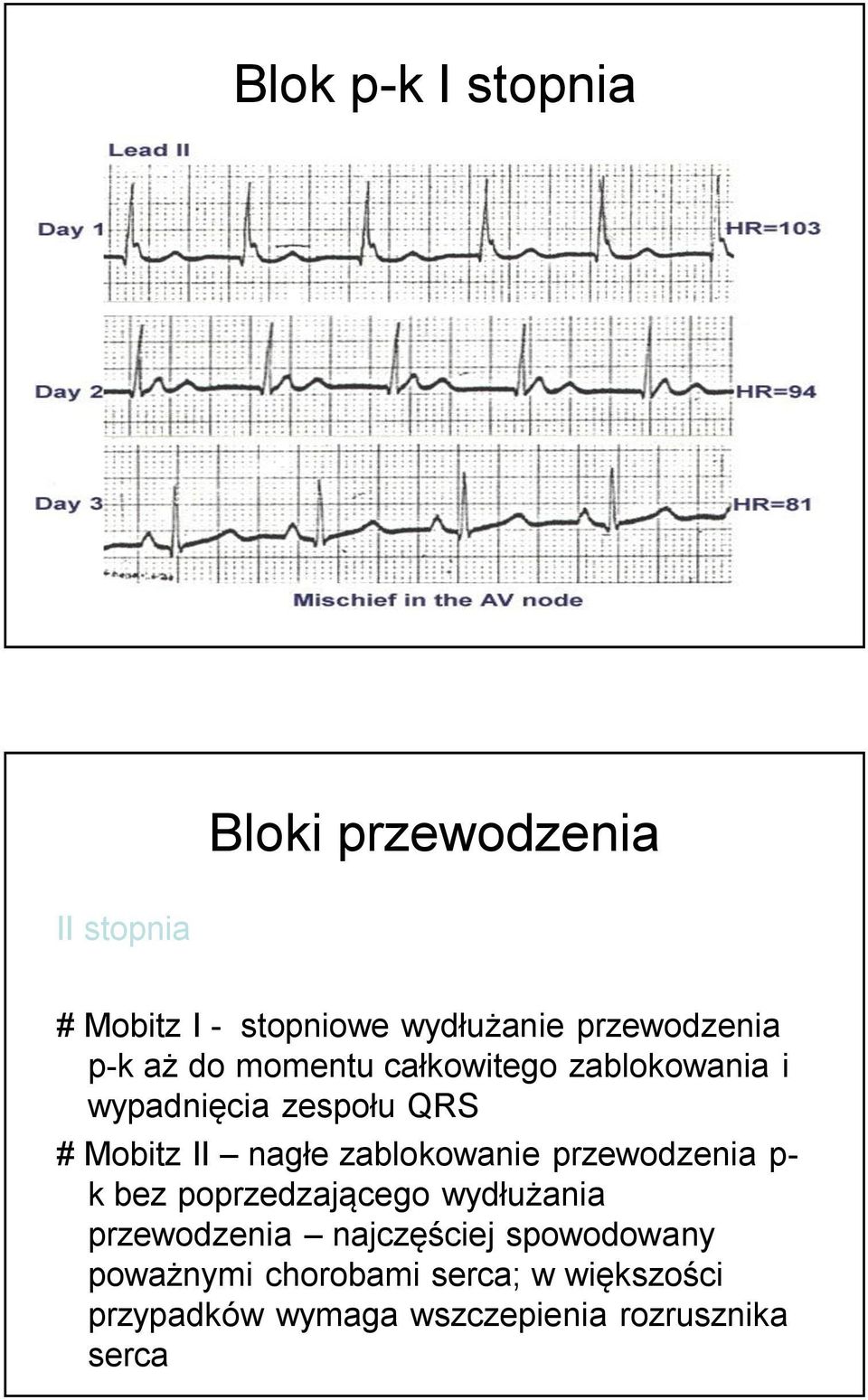 nagłe zablokowanie przewodzenia p- k bez poprzedzającego wydłużania przewodzenia najczęściej