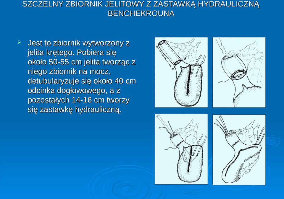 Pobiera się około 50-55 cm jelita tworząc z niego zbiornik na mocz,