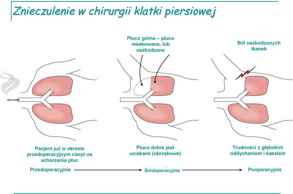 Przedoperacyjnie Płuco dolne jest uciskane (obrzękowe)