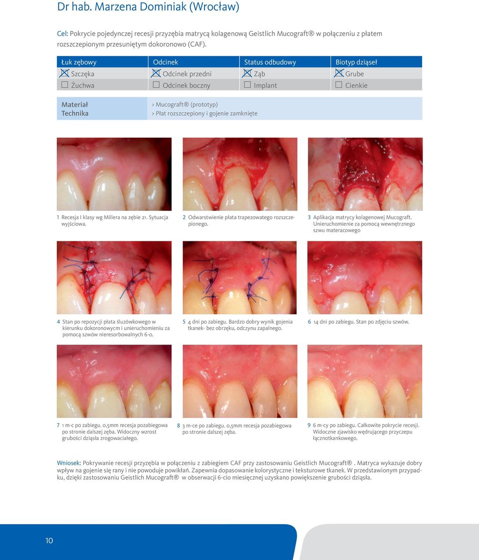 zamknięte 1 Recesja I klasy wg Millera na zębie 21. Sytuacja wyjściowa. 2 Odwarstwienie płata trapezowatego rozszczepionego. 3 Aplikacja matrycy kolagenowej Mucograft.