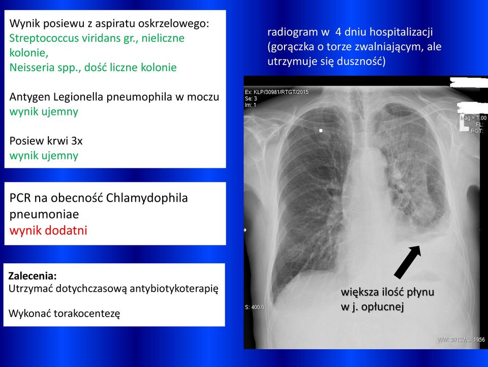 duszność) Antygen Legionella pneumophila w moczu wynik ujemny Posiew krwi 3x wynik ujemny PCR na obecność
