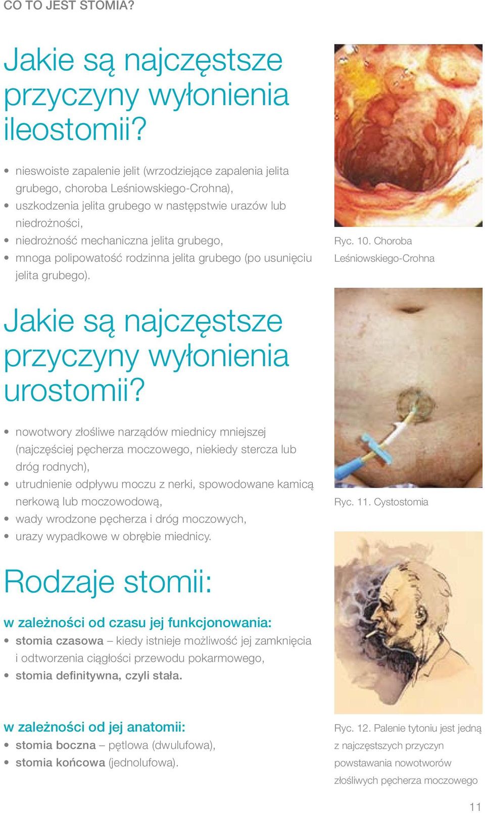grubego, mnoga polipowatość rodzinna jelita grubego (po usunięciu jelita grubego). Ryc. 10. Choroba Leśniowskiego-Crohna Jakie są najczęstsze przyczyny wyłonienia urostomii?