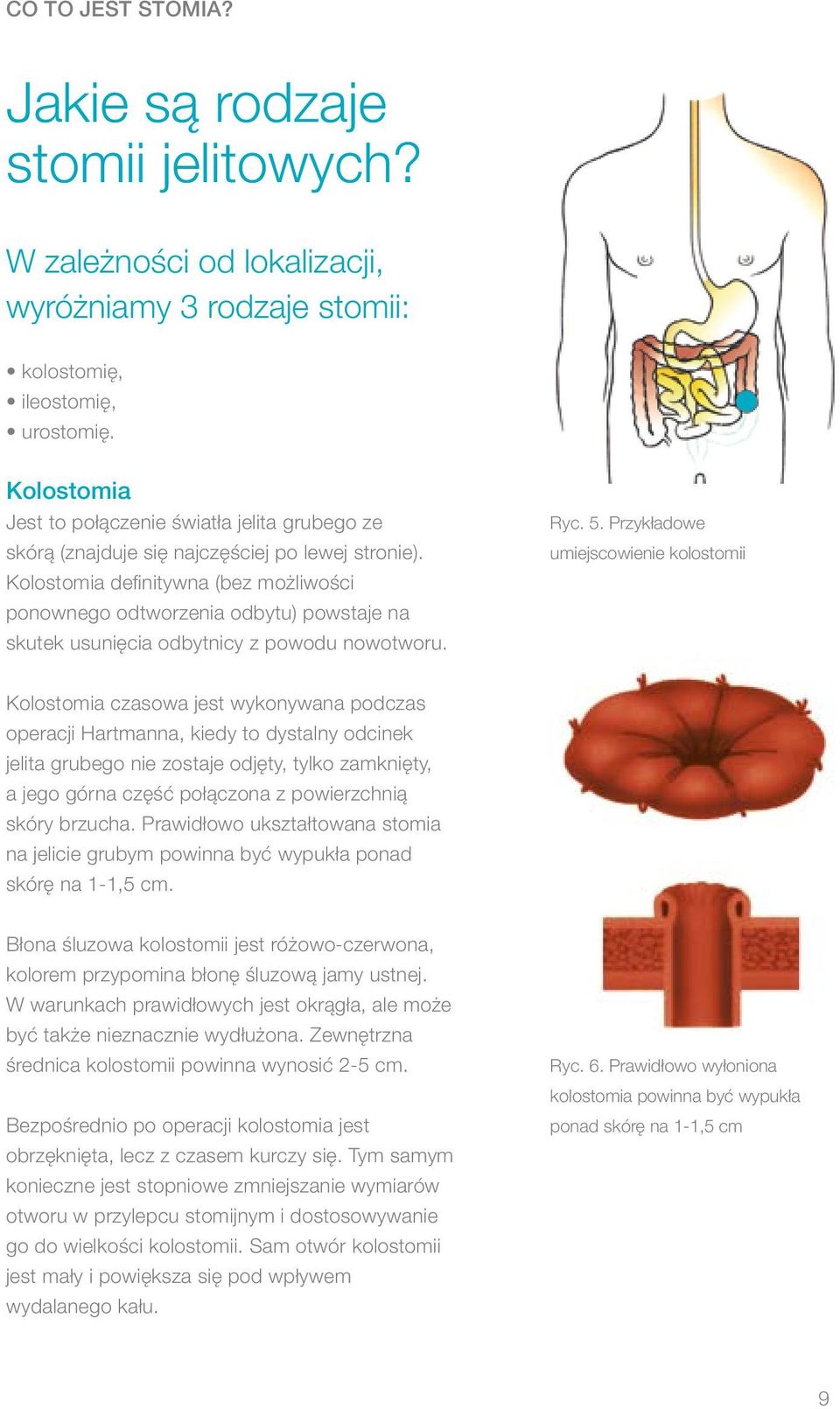 Kolostomia definitywna (bez możliwości ponownego odtworzenia odbytu) powstaje na skutek usunięcia odbytnicy z powodu nowotworu. Ryc. 5.