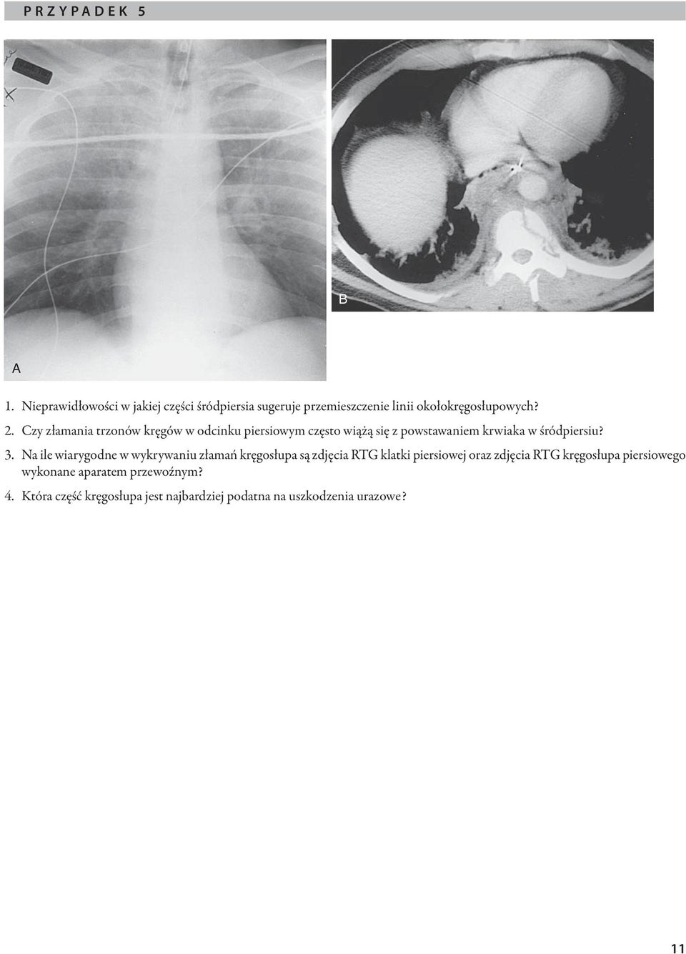 Czy złamania trzonów kręgów w odcinku piersiowym często wiążą się z powstawaniem krwiaka w śródpiersiu? 3.