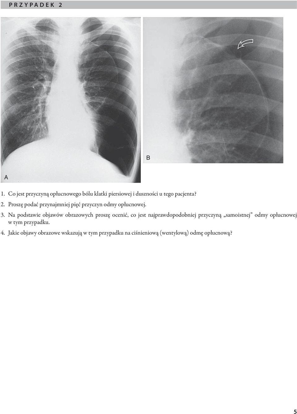 Proszę podać przynajmniej pięć przyczyn odmy opłucnowej. 3.