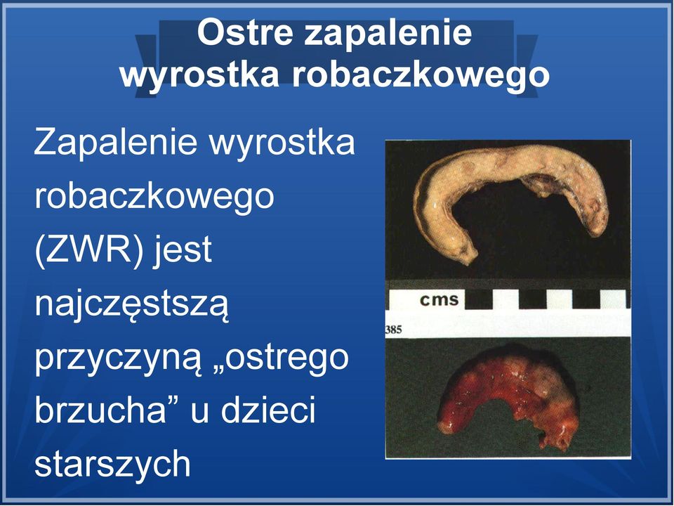 robaczkowego (ZWR) jest