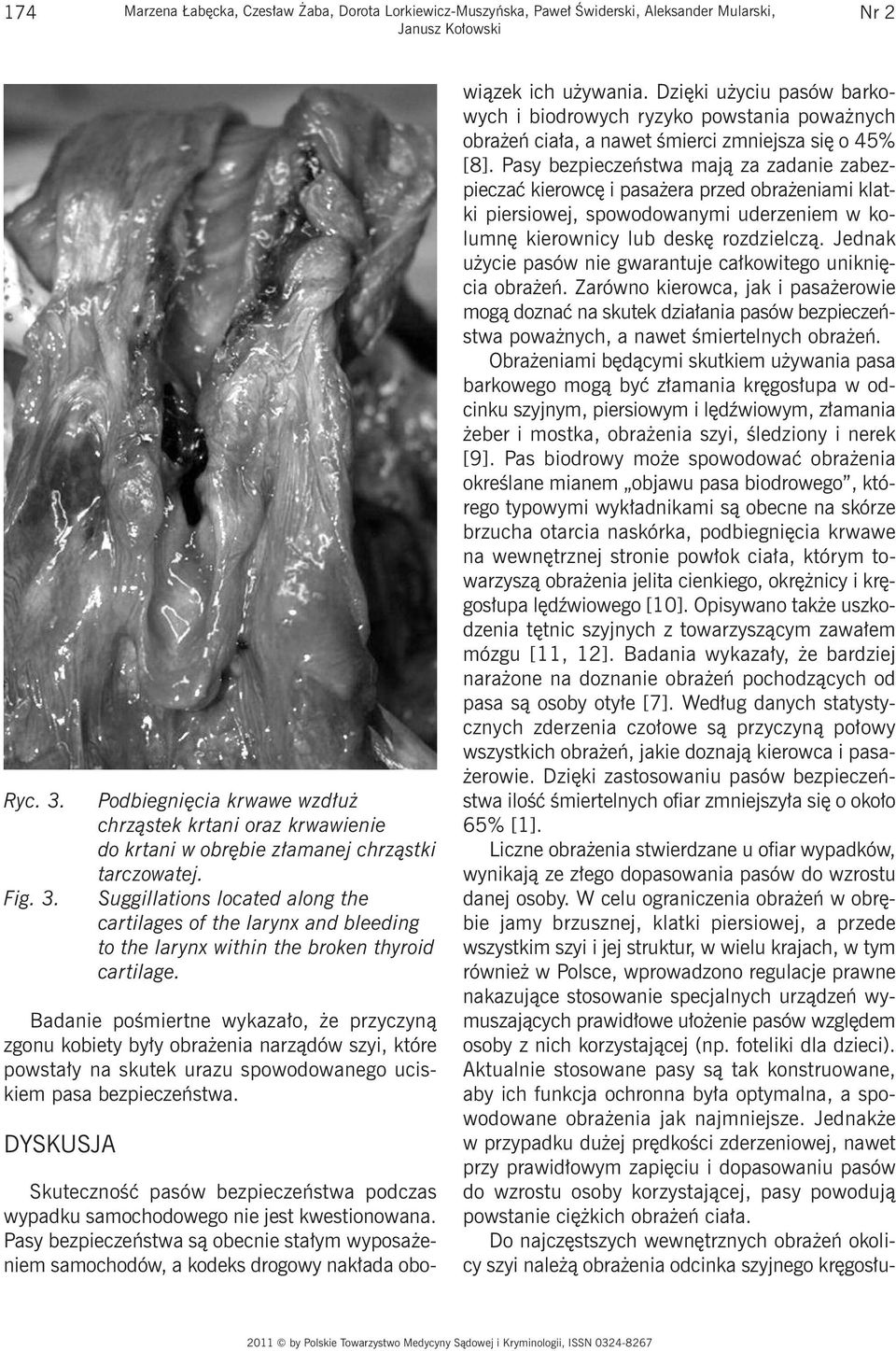 Suggillations located along the cartilages of the larynx and bleeding to the larynx within the broken thyroid cartilage.