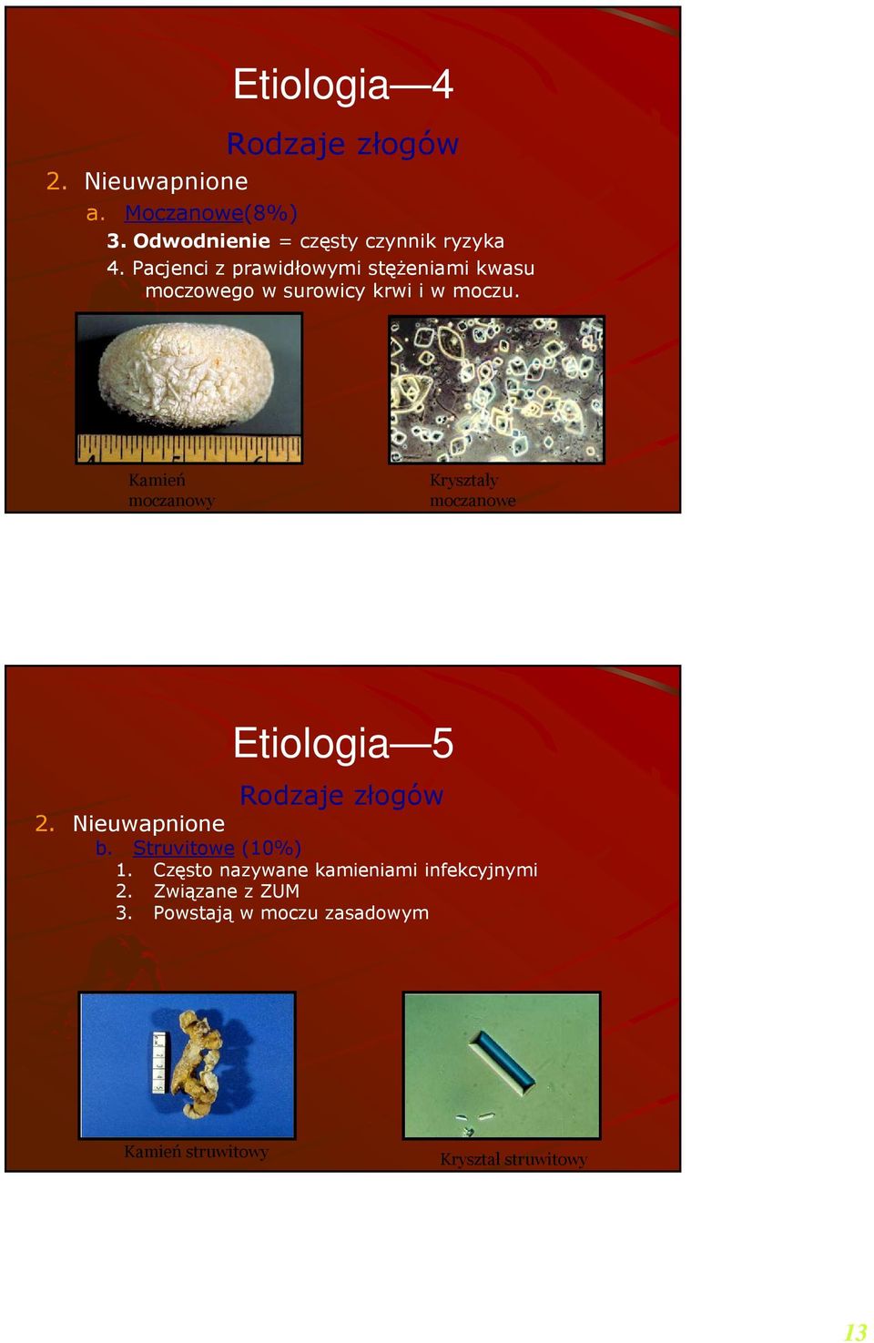 Kamień moczanowy Kryształy moczanowe Etiologia 5 Rodzaje złogów 2. Nieuwapnione b. Struvitowe (10%) 1.