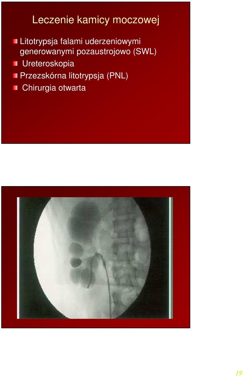 pozaustrojowo (SWL) Ureteroskopia