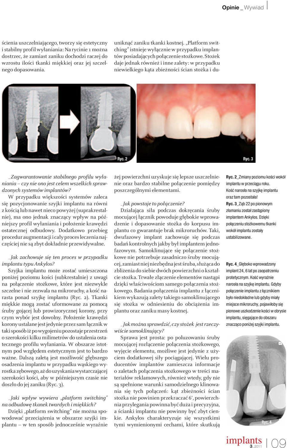 W przypadku większości systemów zaleca się pozycjonowanie szyjki implantu na równi z kością lub nawet nieco powyżej (suprakrestalnie), ma ono jednak znaczący wpływ na póź - niejszy profil wyłaniania