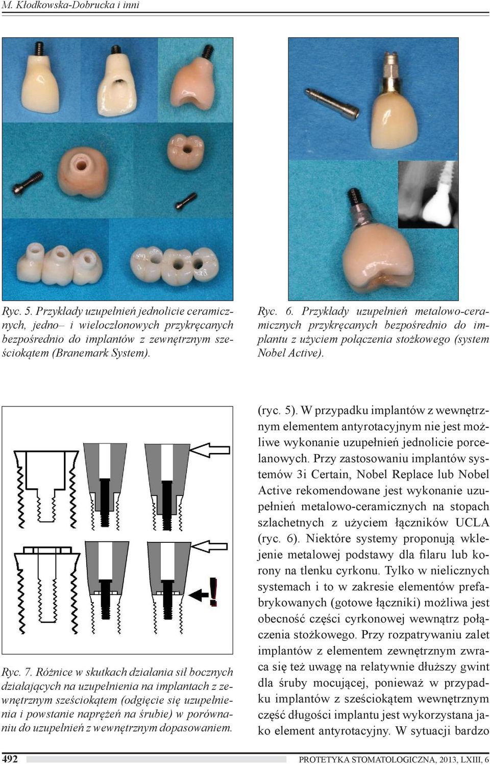Różnice w skutkach działania sił bocznych działających na uzupełnienia na implantach z zewnętrznym sześciokątem (odgięcie się uzupełnienia i powstanie naprężeń na śrubie) w porównaniu do uzupełnień z