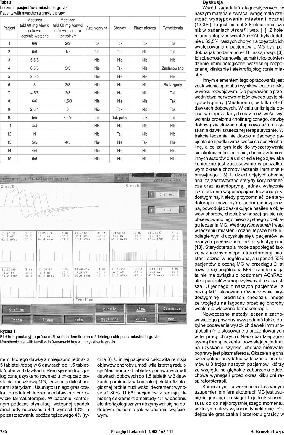 miastenia gravis. Myasthenic test with tensilon in 9-years-old boy with myasthenia gravis. Azathiopryna 1 / / / 1/./,/ /.