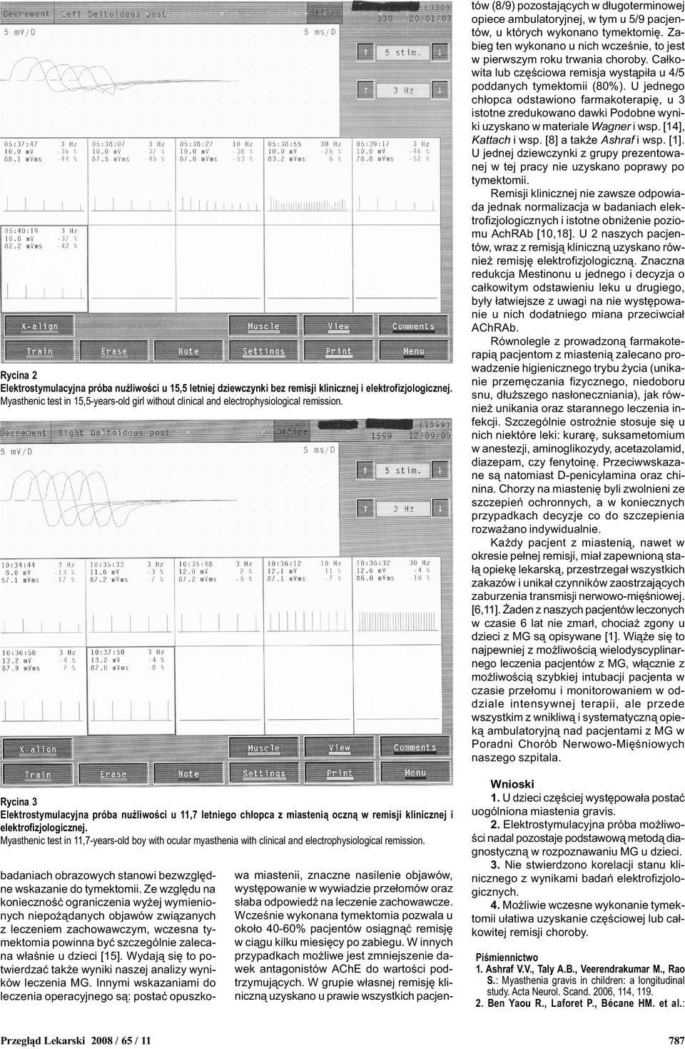Rycina Elektrostymulacyjna próba nu liwoœci u 11,7 letniego ch³opca z miasteni¹ oczn¹ w remisji klinicznej i elektrofizjologicznej.