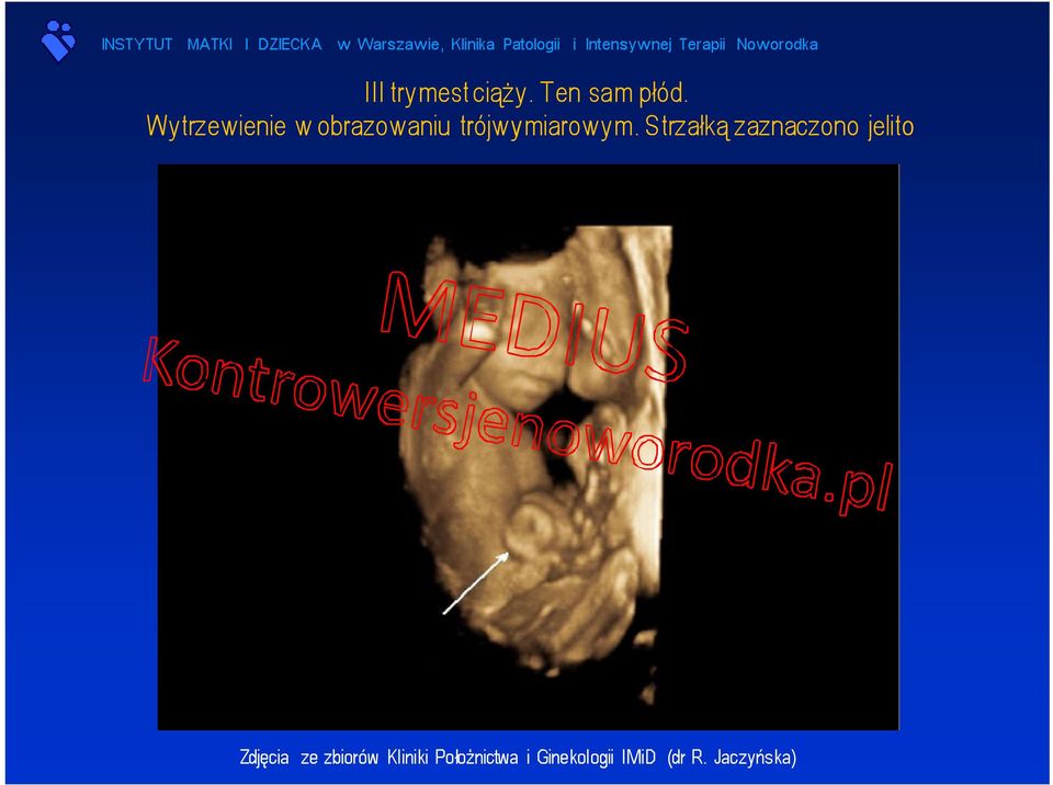 Strzałką zaznaczono jelito Zdjęcia ze