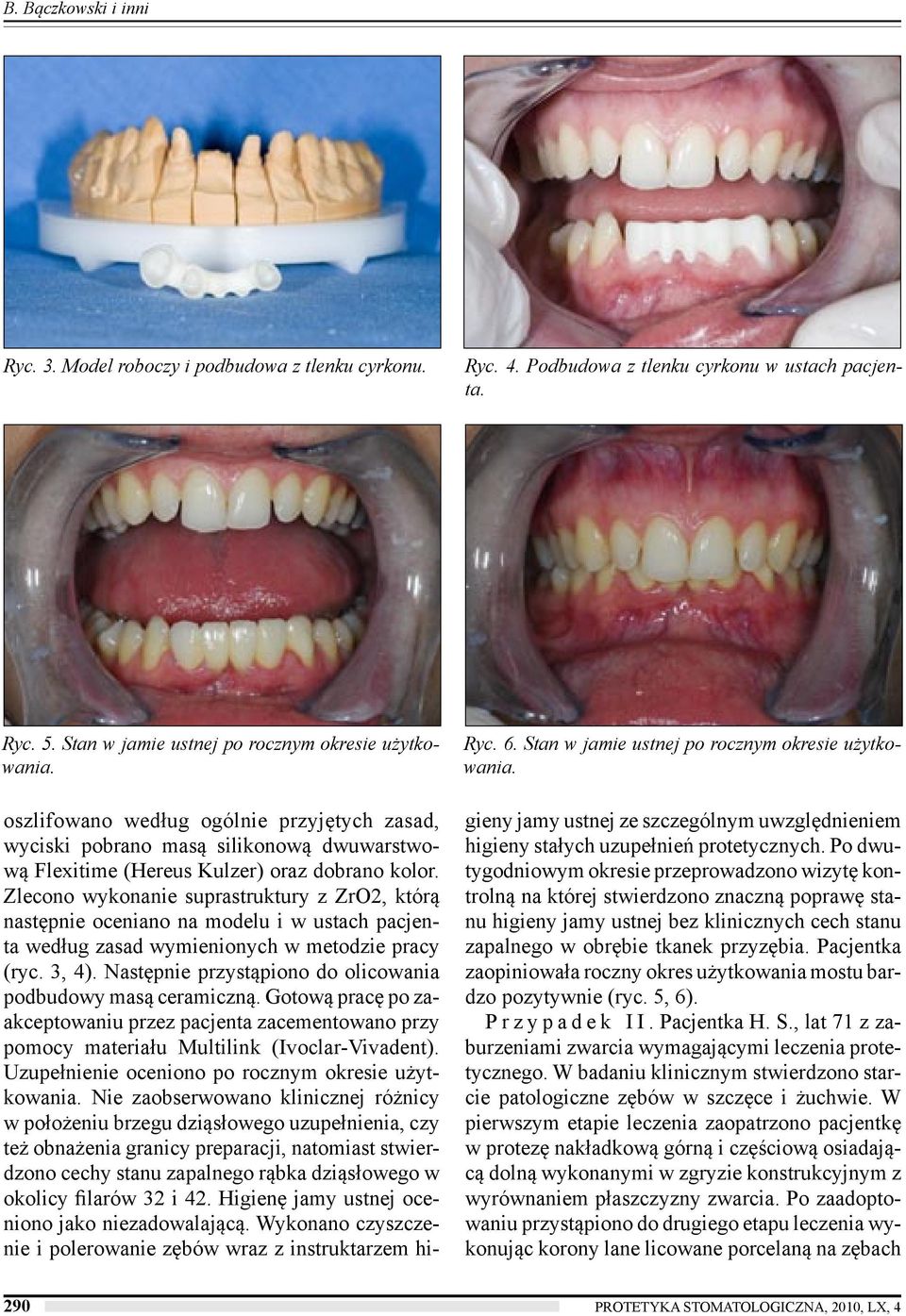 Zlecono wykonanie suprastruktury z ZrO2, którą następnie oceniano na modelu i w ustach pacjenta według zasad wymienionych w metodzie pracy (ryc. 3, 4).