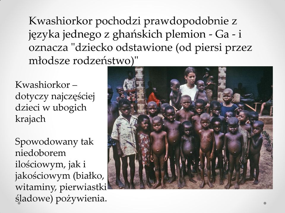 Kwashiorkor dotyczy najczęściej dzieci w ubogich krajach Spowodowany tak