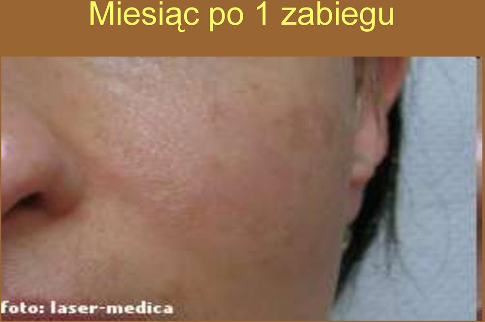 zabiegu