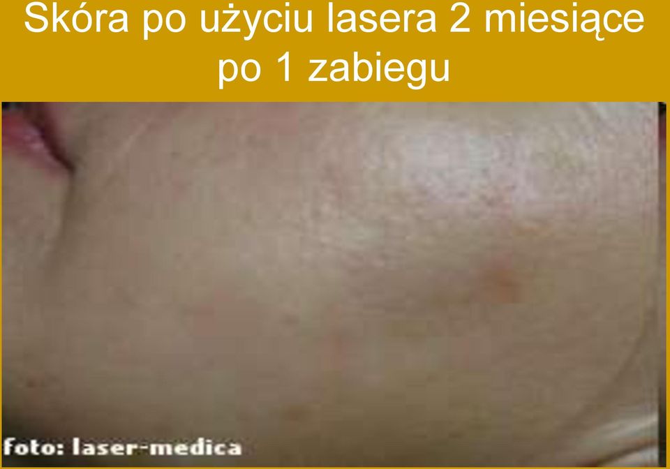 lasera 2