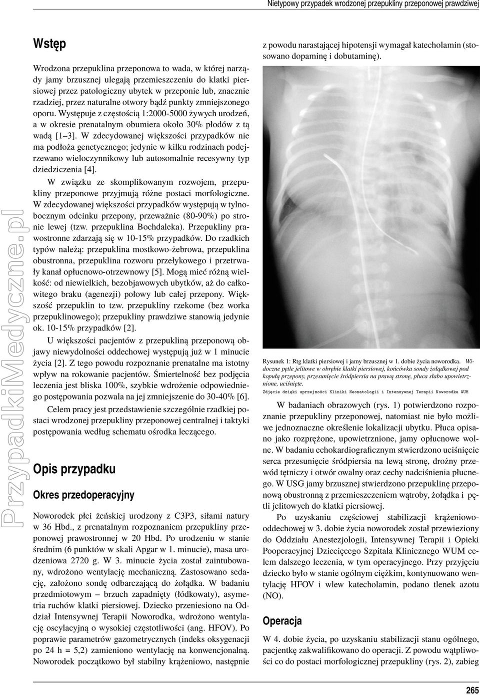 Występuje z częstością 1:2000-5000 żywych urodzeń, a w okresie prenatalnym obumiera około 30% płodów z tą wadą [1 3].