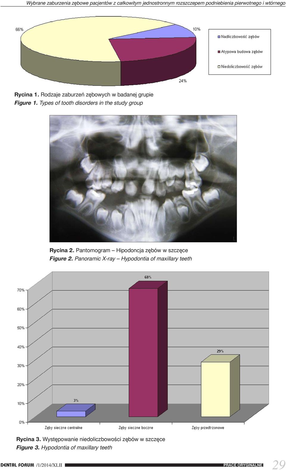 Types of tooth disorders in the study group Rycina 2. Pantomogram Hipodoncja zębów w szczęce Figure 2.