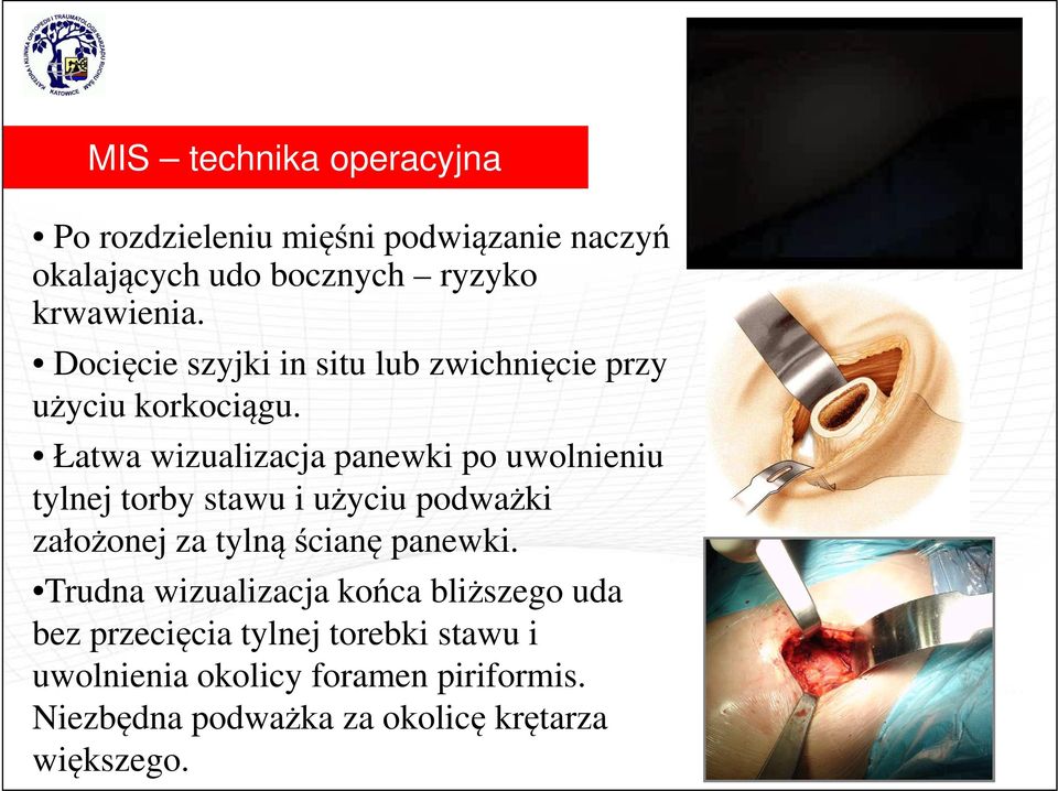 Łatwa wizualizacja panewki po uwolnieniu tylnej torby stawu i użyciu podważki założonej za tylną ścianę panewki.