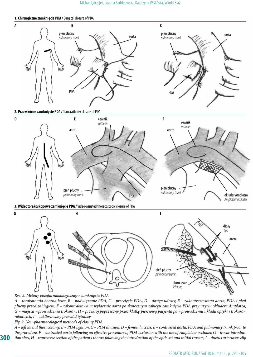 Przezskórne zamknięcie PDA / Transcatheter closure of PDA D E aorta cewnik catheter F aorta cewnik catheter 3.
