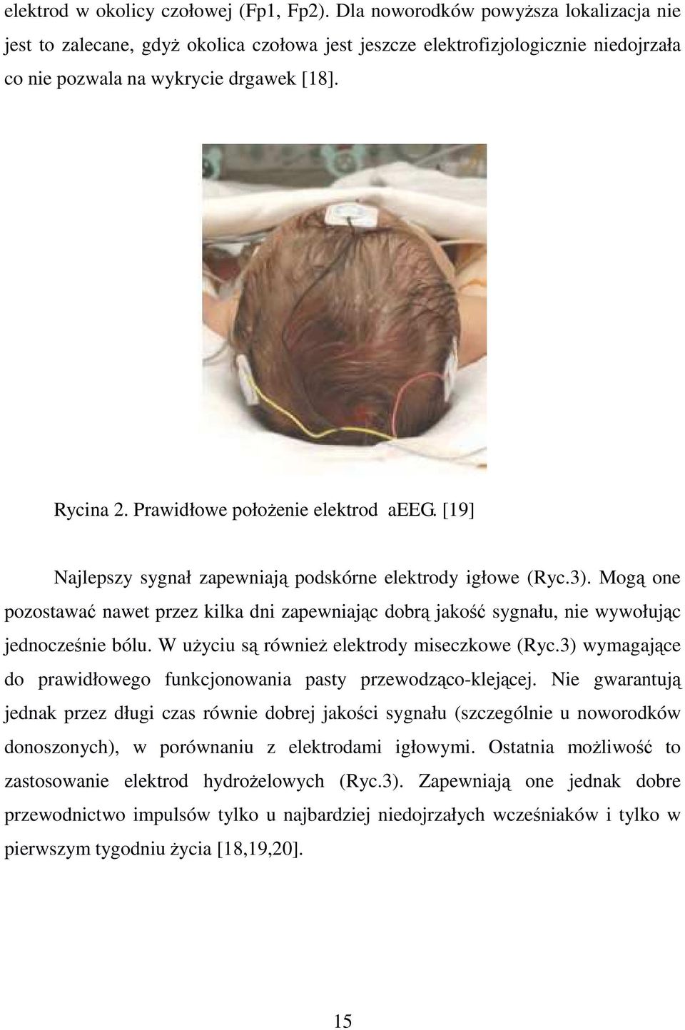 Prawidłowe położenie elektrod aeeg. [19] Najlepszy sygnał zapewniają podskórne elektrody igłowe (Ryc.3).