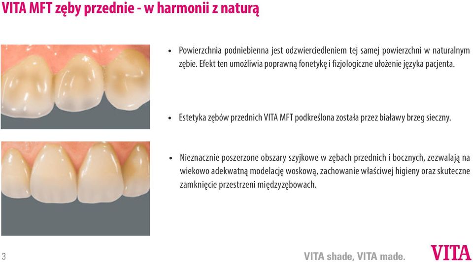 Estetyka zębów przednich VITA MFT podkreślona została przez białawy brzeg sieczny.