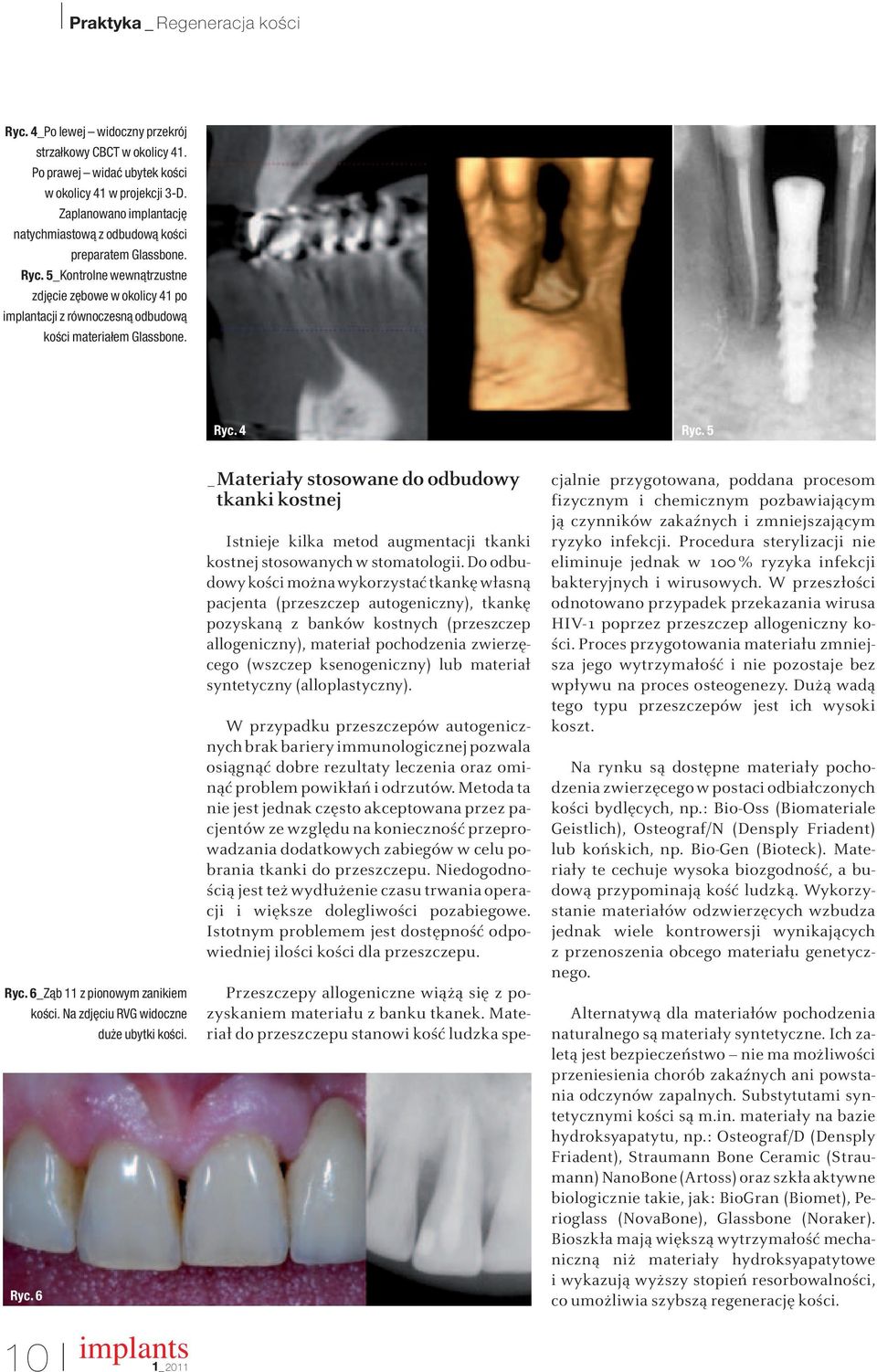 Na zdj ciu RVG widoczne du e ubytki koêci. Ryc. 6 10 implants _Materiały stosowane do odbudowy tkanki kostnej Istnieje kilka metod augmentacji tkanki kostnej stosowanych w stomatologii.