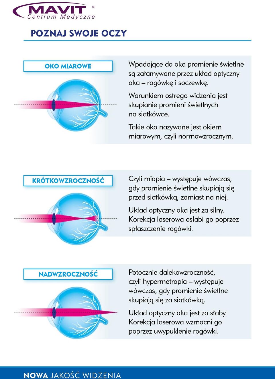 KRÓTKOWZROCZNOŚĆ Czyli miopia występuje wówczas, gdy promienie świetlne skupiają się przed siatkówką, zamiast na niej. Układ optyczny oka jest za silny.