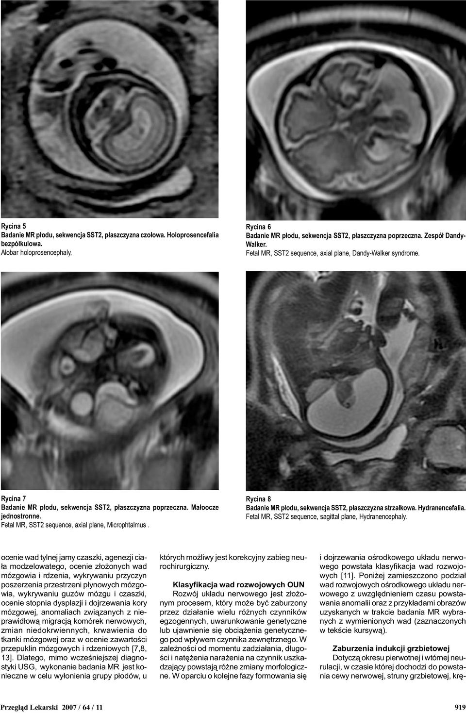 Fetal MR, SST2 sequence, axial plane, Microphtalmus. Rycina 8 Badanie MR p³odu, sekwencja SST2, p³aszczyzna strza³kowa. Hydranencefalia. Fetal MR, SST2 sequence, sagittal plane, Hydranencephaly.