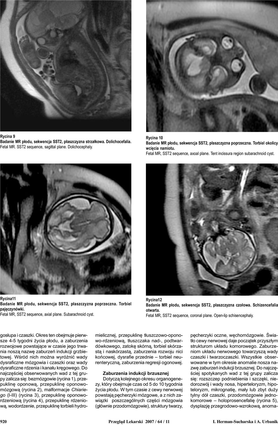 Rycina11 Badanie MR p³odu, sekwencja SST2, p³aszczyzna poprzeczna. Torbiel pajêczynówki. Fetal MR, SST2 sequence, axial plane. Subarachnoid cyst.