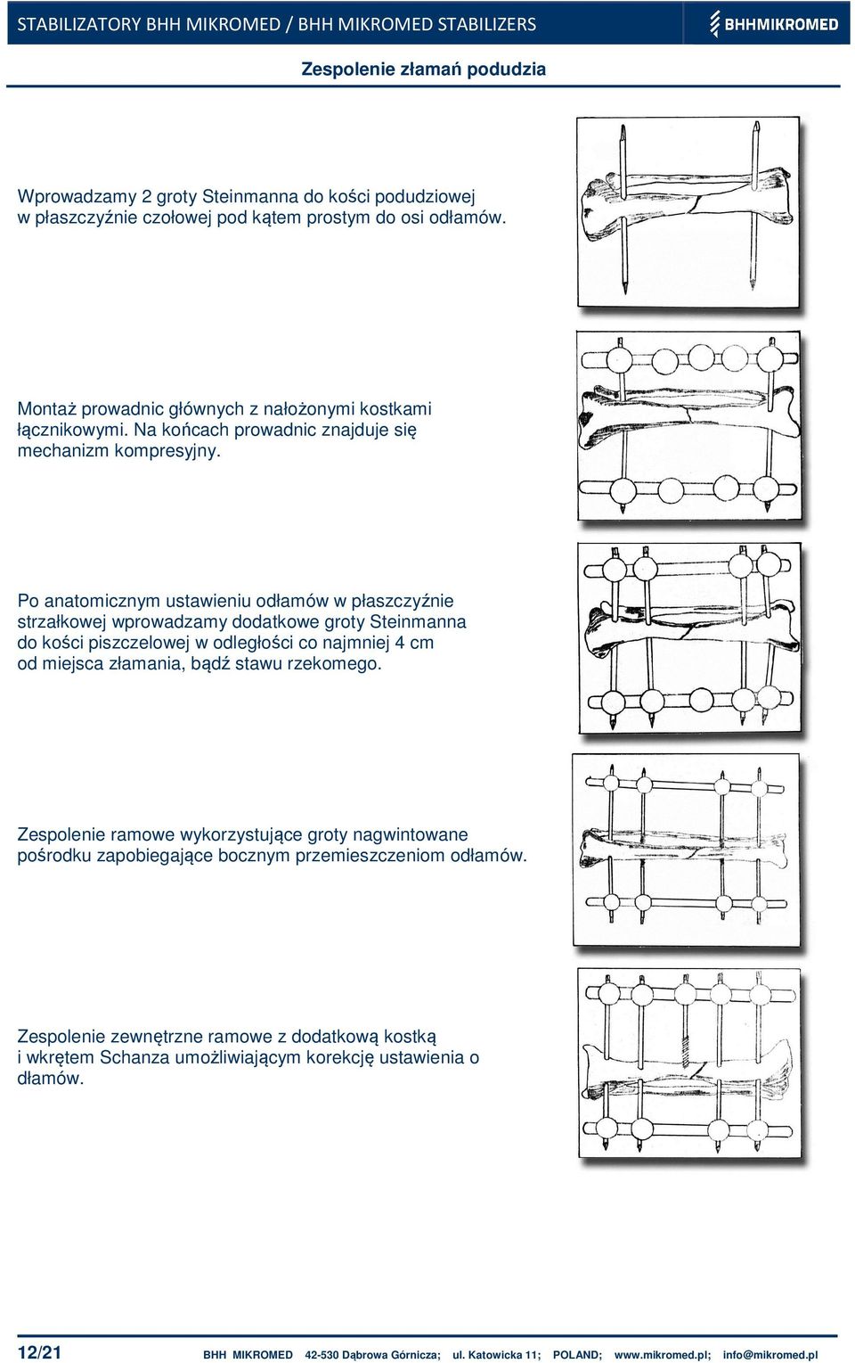 Po anatomicznym ustawieniu odłamów w płaszczyźnie strzałkowej wprowadzamy dodatkowe groty Steinmanna do kości piszczelowej w odległości co najmniej 4 cm od miejsca złamania, bądź stawu