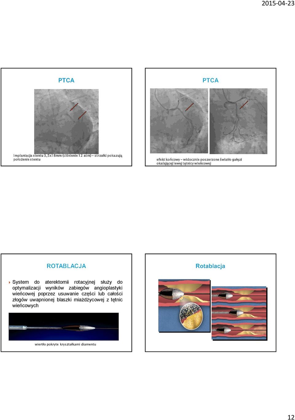 rotacyjnej służy do optymalizacji wyników zabiegów angioplastyki wieńcowej poprzez usuwanie części