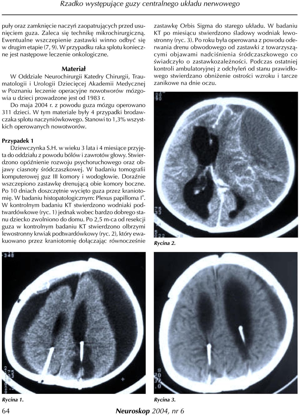 Materia³ W Oddziale Neurochirurgii Katedry Chirurgii, Traumatologii i Urologii Dzieciêcej Akademii Medycznej w Poznaniu leczenie operacyjne nowotworów mózgowia u dzieci prowadzone jest od 1983 r.