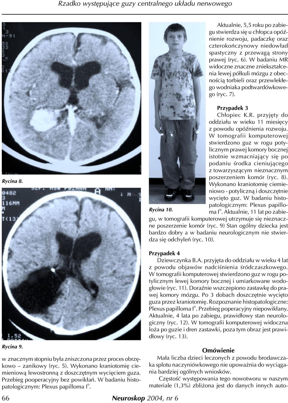 W tomografii komputerowej stwierdzono guz w rogu potylicznym prawej komory bocznej istotnie wzmacniaj¹cy siê po podaniu œrodka cieniuj¹cego z towarzysz¹cym nieznacznym poszerzeniem komór (ryc. 8).