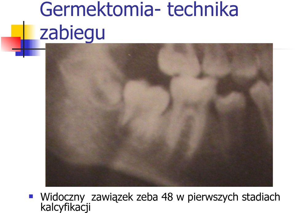 zawiązek zeba 48 w