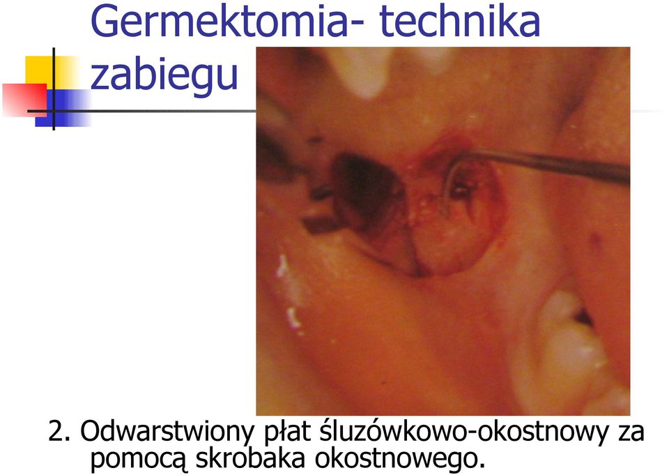 Odwarstwiony płat