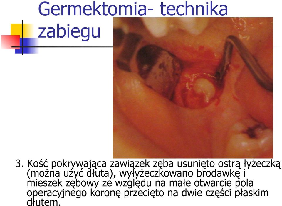 (można użyć dłuta), wyłyżeczkowano brodawkę i mieszek zębowy