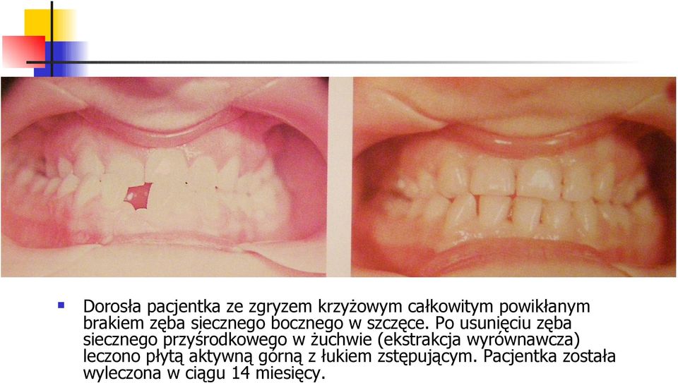 Po usunięciu zęba siecznego przyśrodkowego w żuchwie (ekstrakcja